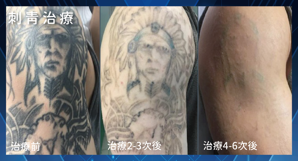 刺青1
